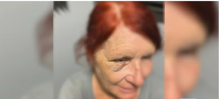 Donna Hansbrough con su ojo herido | Foto: Youtube.com/WJCL News