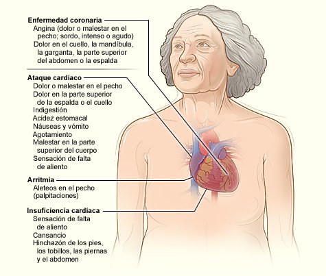 Infografía sobre dolores causados por ataques al corazón | Foto: Wikimedia