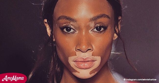 La emocionante reacción de mujer con vitiligo que fue elegida "ángel" de Victoria's Secret