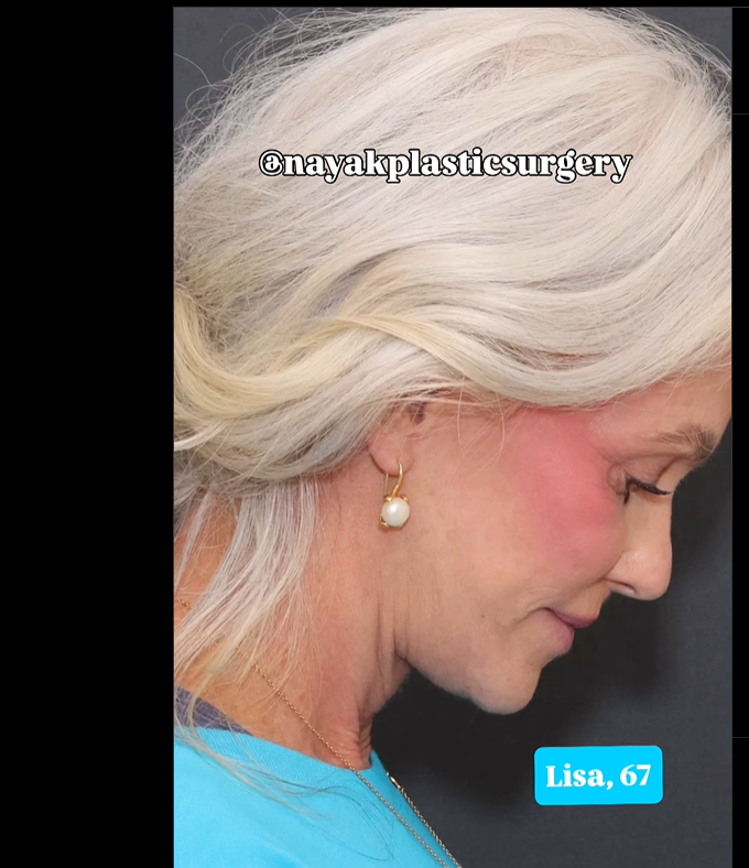 Lisa posa tras la intervención, en un post del 1 de junio de 2025 | Fuente: Instagram/nayakplasticsurgery