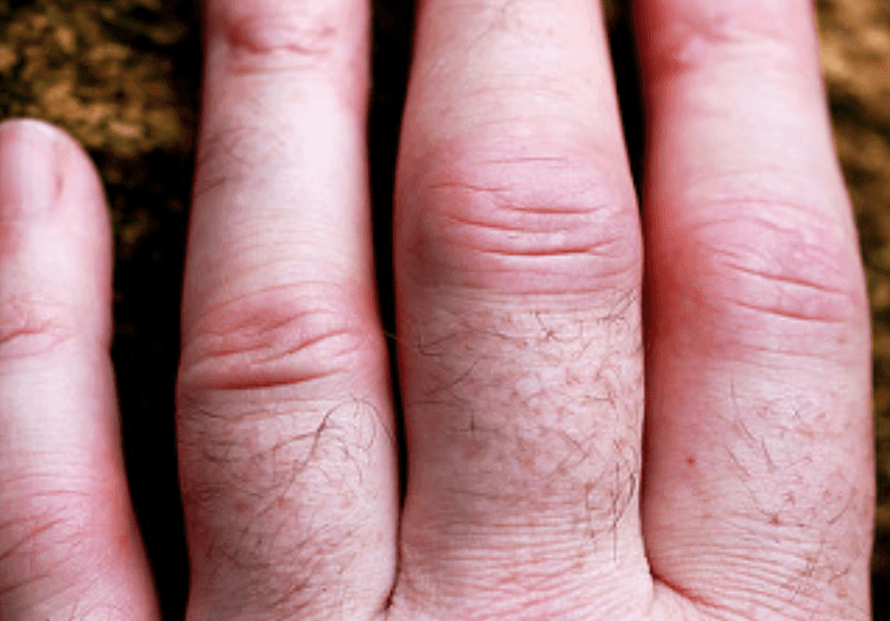 Inflamación en la articulación de los dedos. | Imagen: Flickr