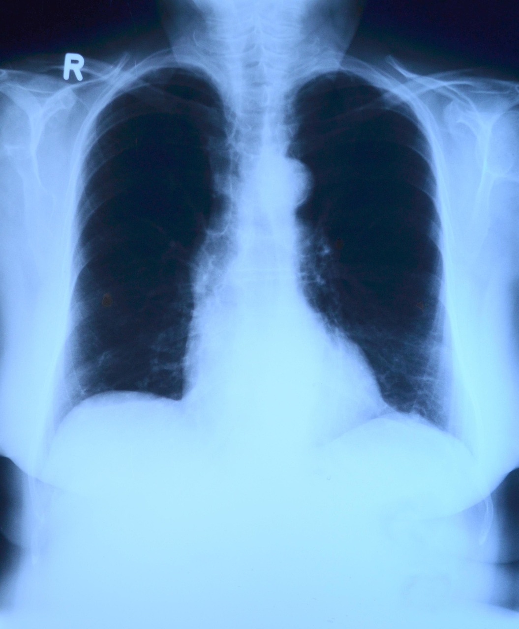 Una radiografía de pulmones | Fuente: Pixabay