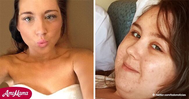 Joven mujer con cáncer dice que su novio la dejó por haber subido de peso