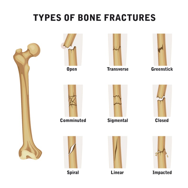 Tipos de fracturas óseas. Fuente: Shutterstock