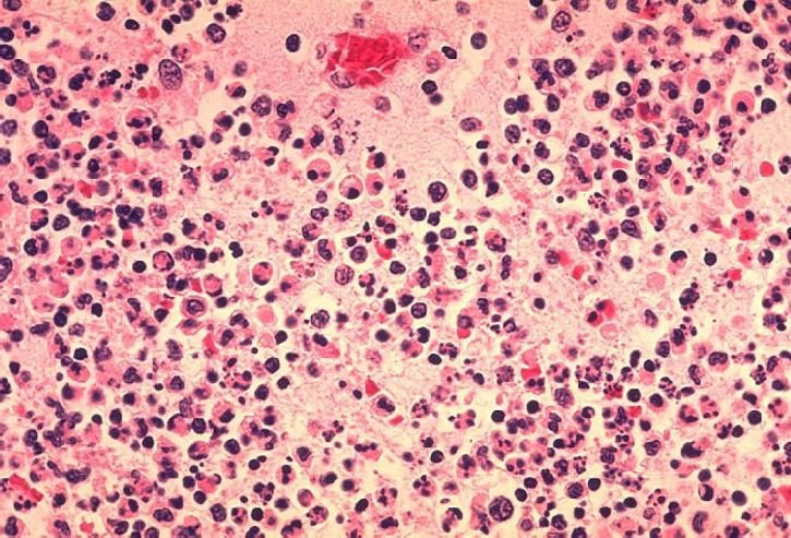 Histopatología ganglios linfáticos. | Imagen: Pixnio
