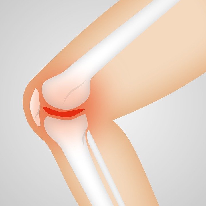 Rodilla con artritis. | Foto: Pixabay