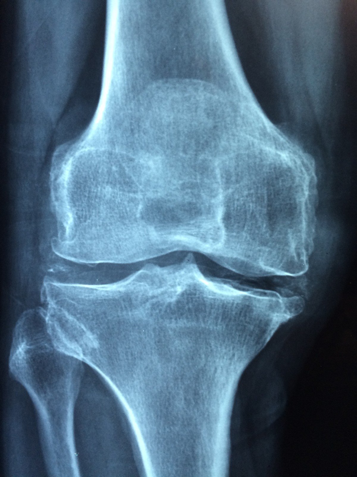 Placa de una rodilla. | Imagen: PxHere