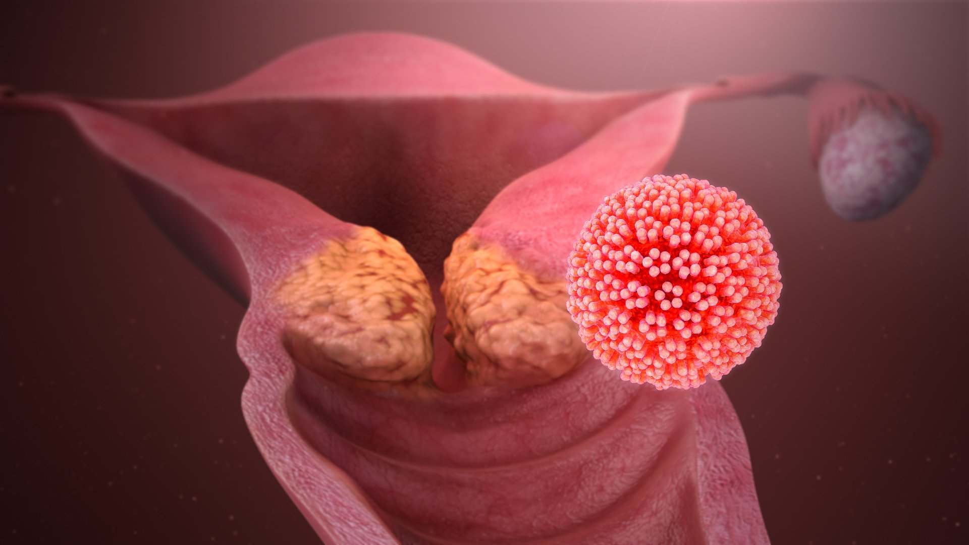 Cáncer cervical causado por el virus del papiloma humano (VPH). | Imagen: Wikipedia