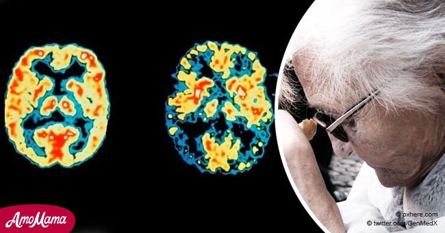 Por primera vez se ha neutralizado el gen del Alzheimer en células del cerebro humano