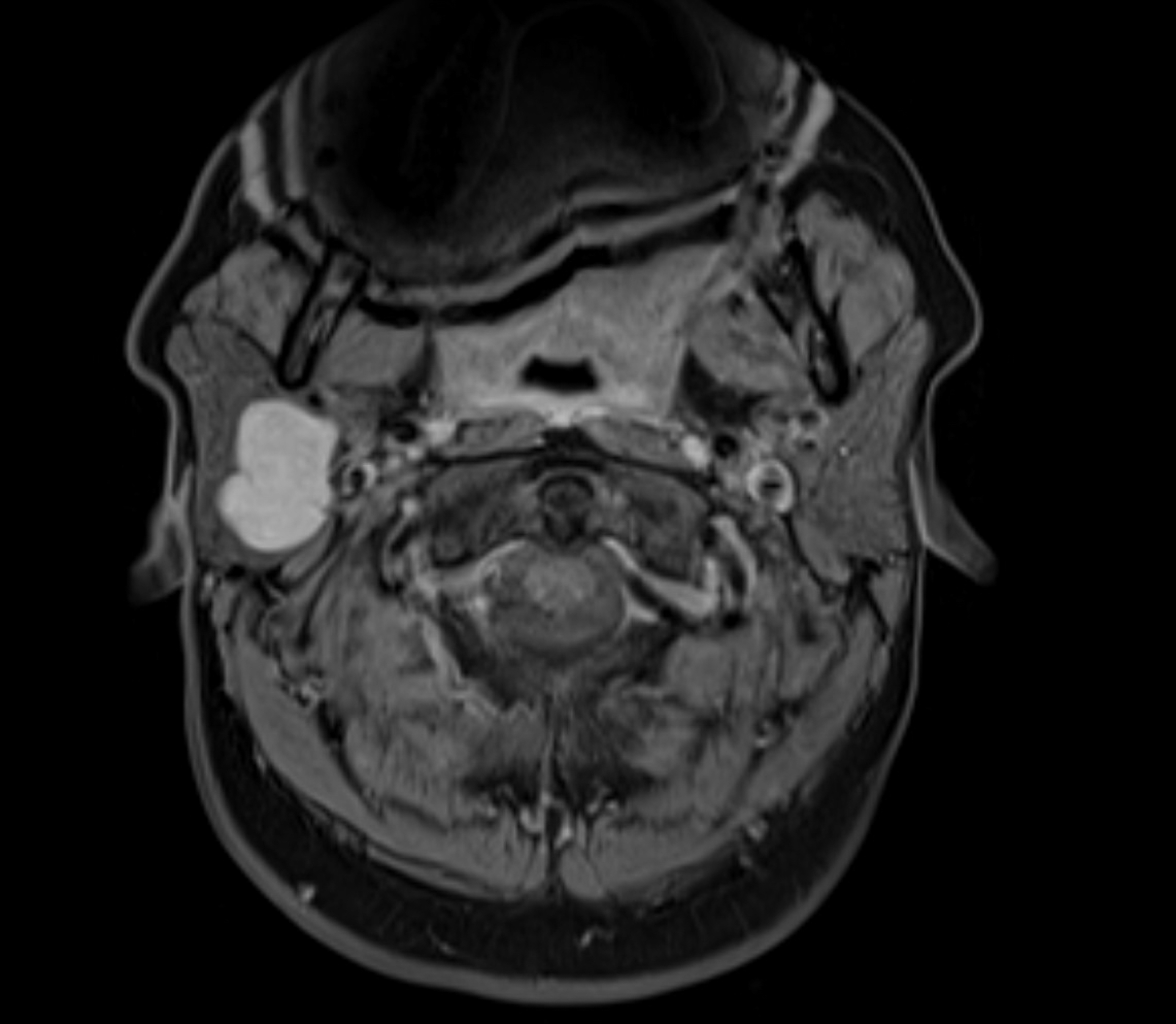 Resonancia magnética axial multiparamétrica que muestra un tumor de la glándula parótida | Fuente: Getty Images