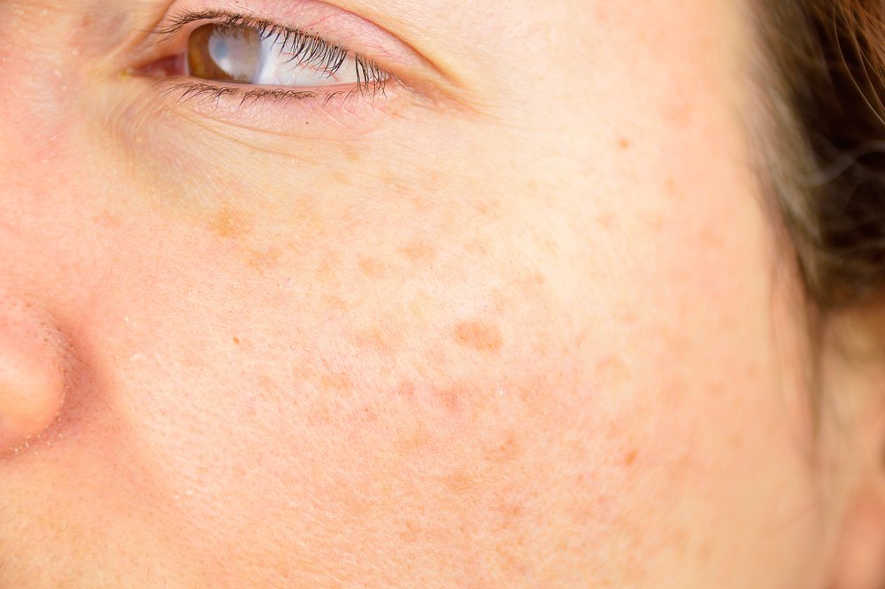 La mejilla de una mujer con manchas causadas por la sol de exposición. | Foto: Shutterstock