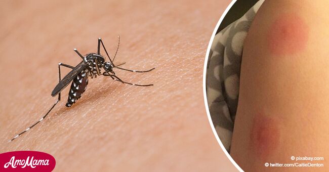 Picadura de mosquito ordinaria puede desatar el "síndrome Skeeter", cuídate de sus síntomas