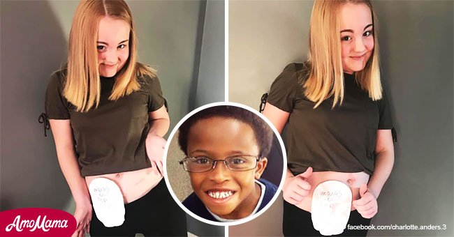 Chica publicó fotos con su bolsa de ostomía tras niño con el mismo problema suicidarse por burlas