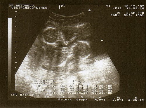 Gemelos en el útero de una madre-Imagen tomada de Flickr