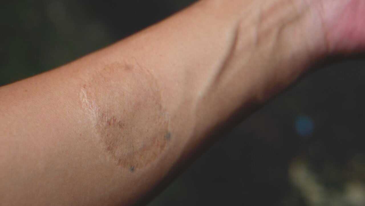 Una cicatriz ovalada en la mano de una mujer | Fuente: Shutterstock