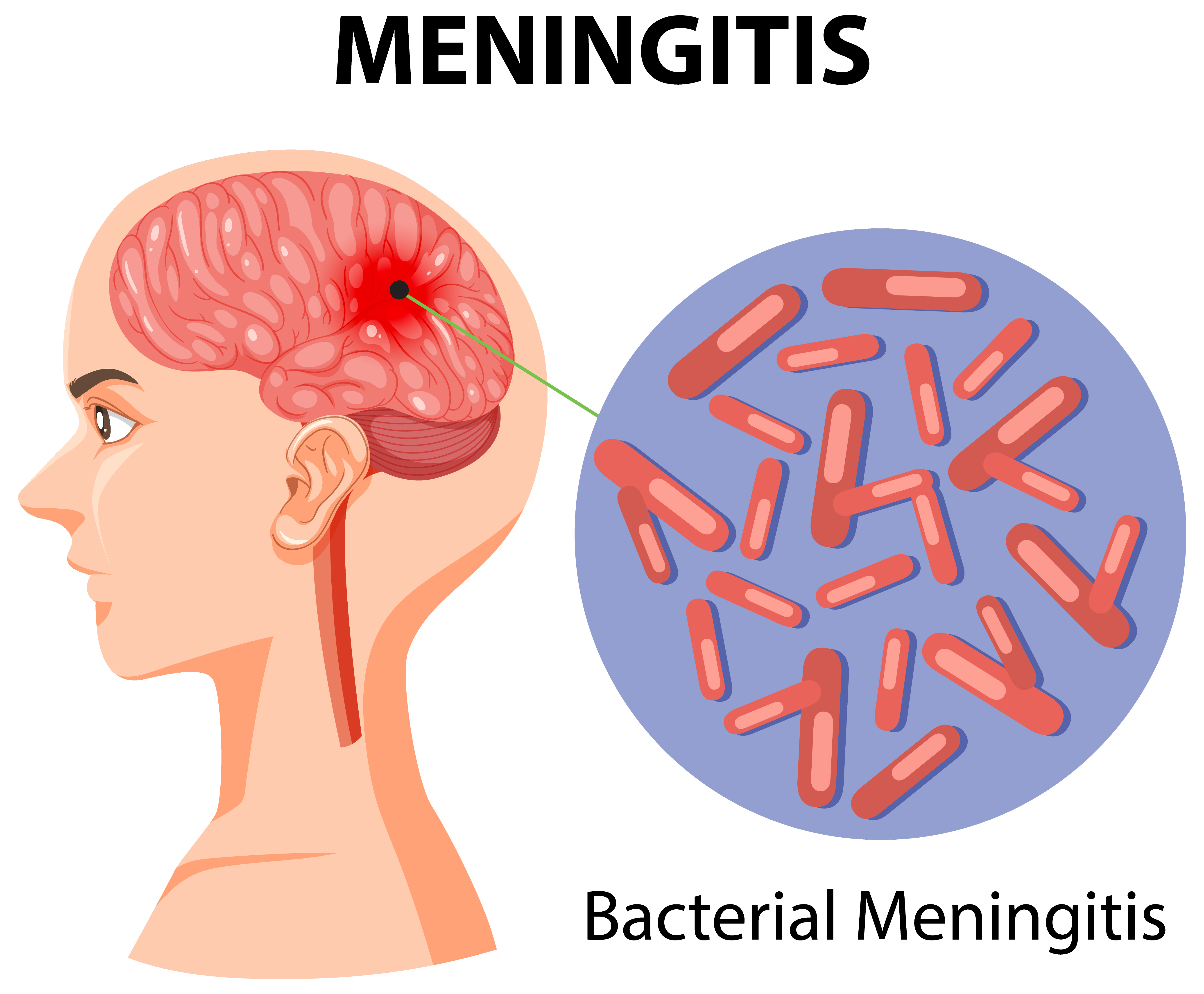Esquema de un cerebro infectado de meningitis | Fuente: Getty images