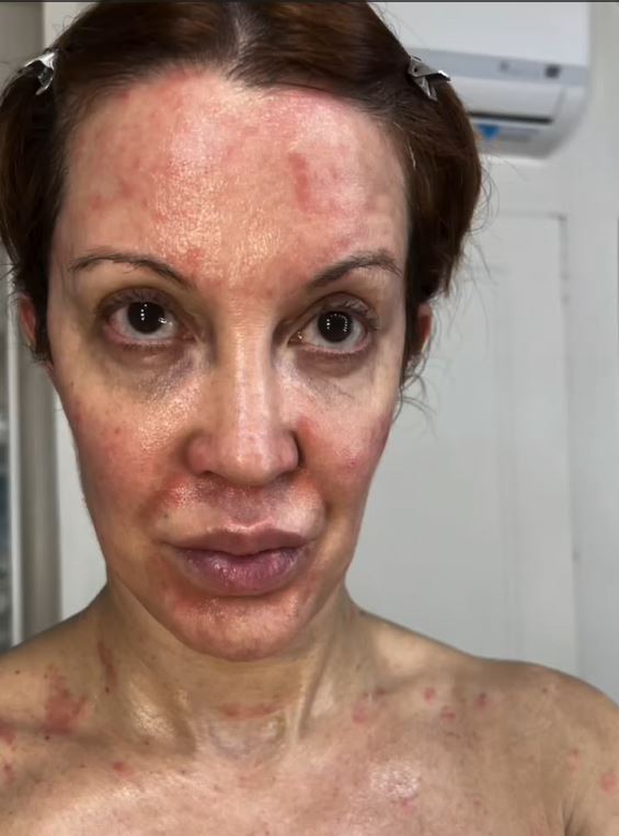 Miriam Lanzoni muestra las lesiones en su piel provocadas por la psoriasis | Fuente: Instagram/miriamlanzoni