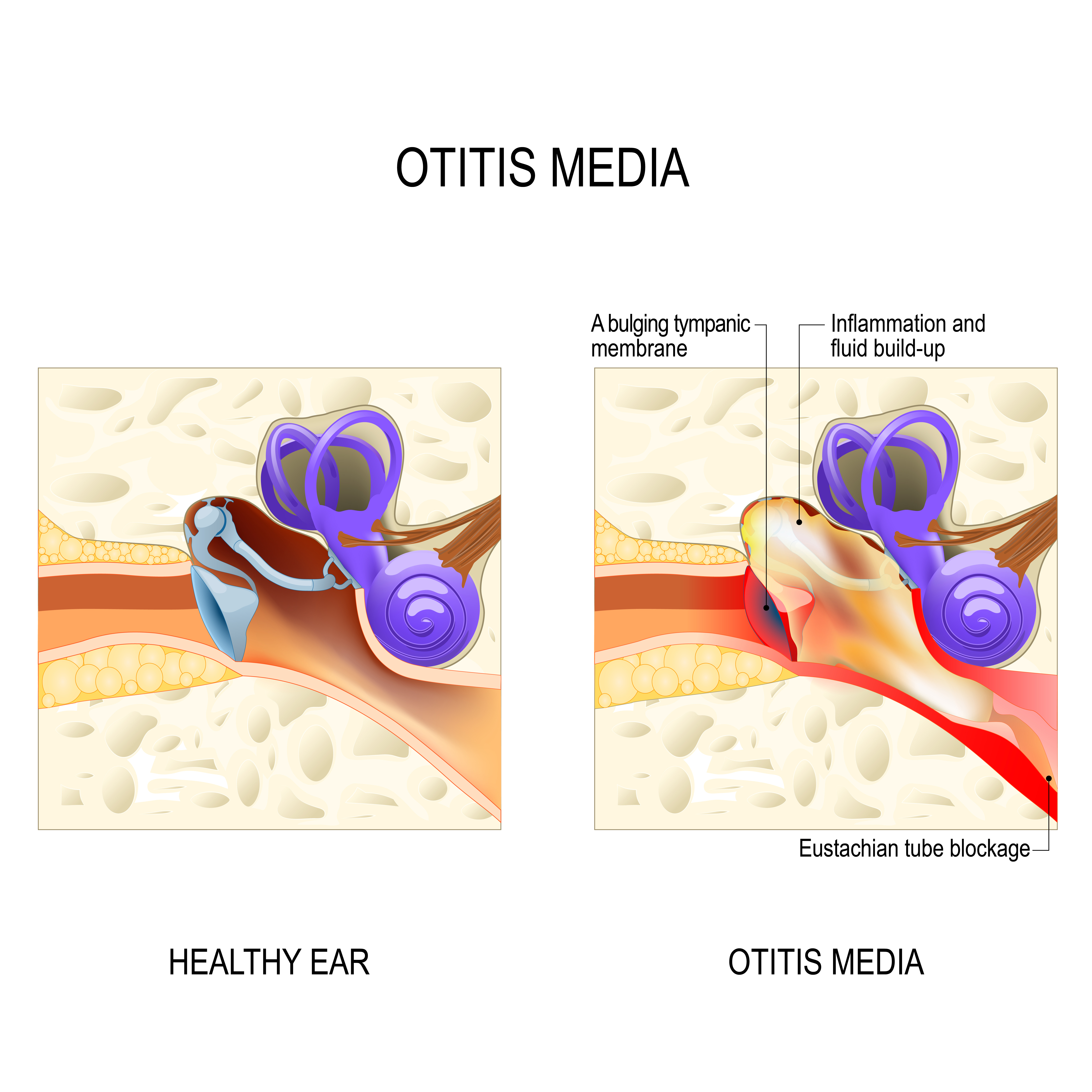 Ilustración que compara un oído sano con uno con otitis media, una afección que causa inflamación y acumulación de líquido en el oído medio | Fuente: Getty Images