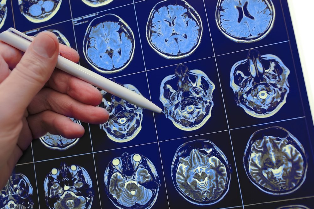Médico señalando con la pluma un problema neurológico en el resultado del estudio de resonancia magnética. Fuente: Shutterstock