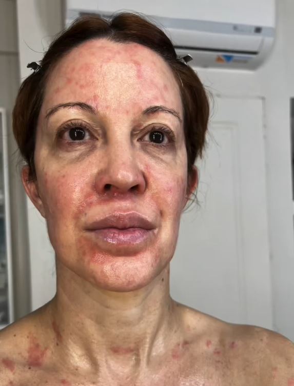 Miriam Lanzoni muestra las lesiones en su piel provocadas por la psoriasis | Fuente: Instagram/miriamlanzoni