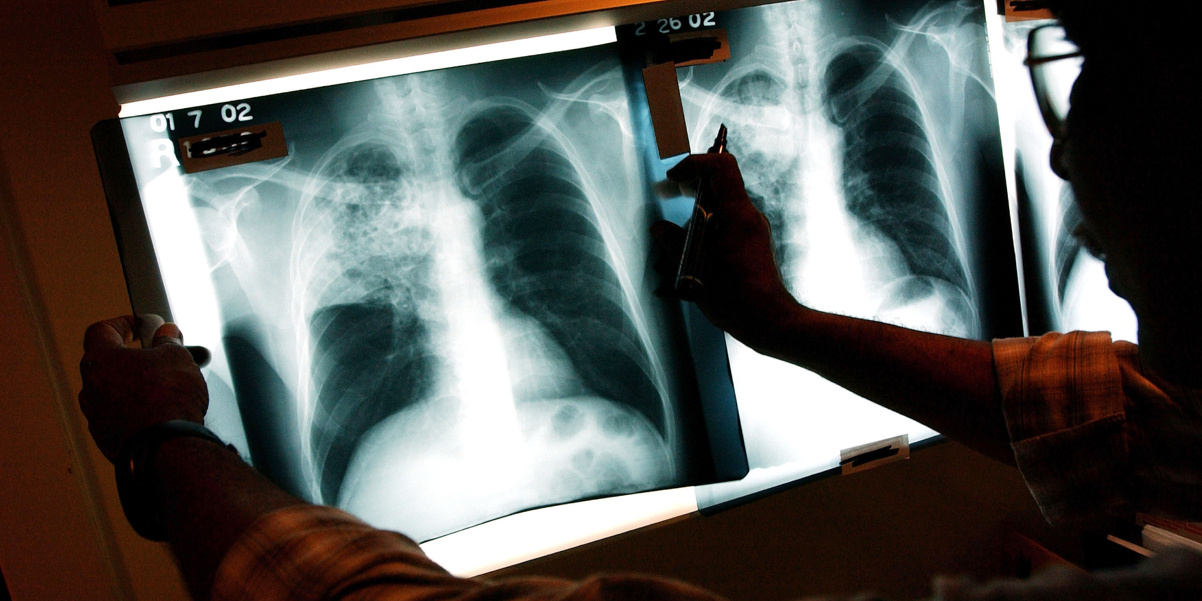 Un médico revisa las radiografías de un paciente con tuberculosis (TB) | Fuente: Getty Images