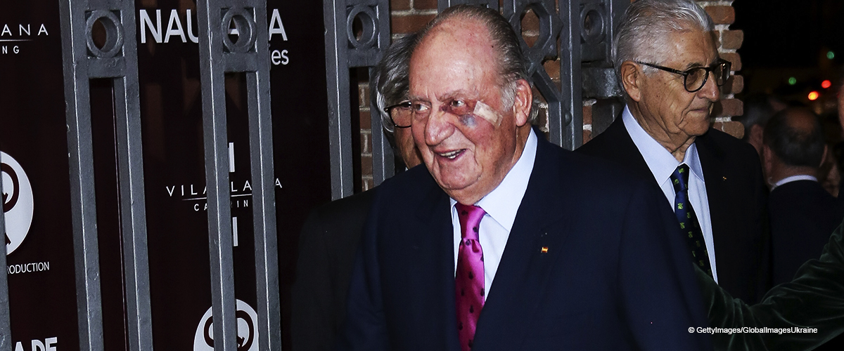 No solo un moretón: El rey Juan Carlos fue operado por cáncer de piel en su mejilla