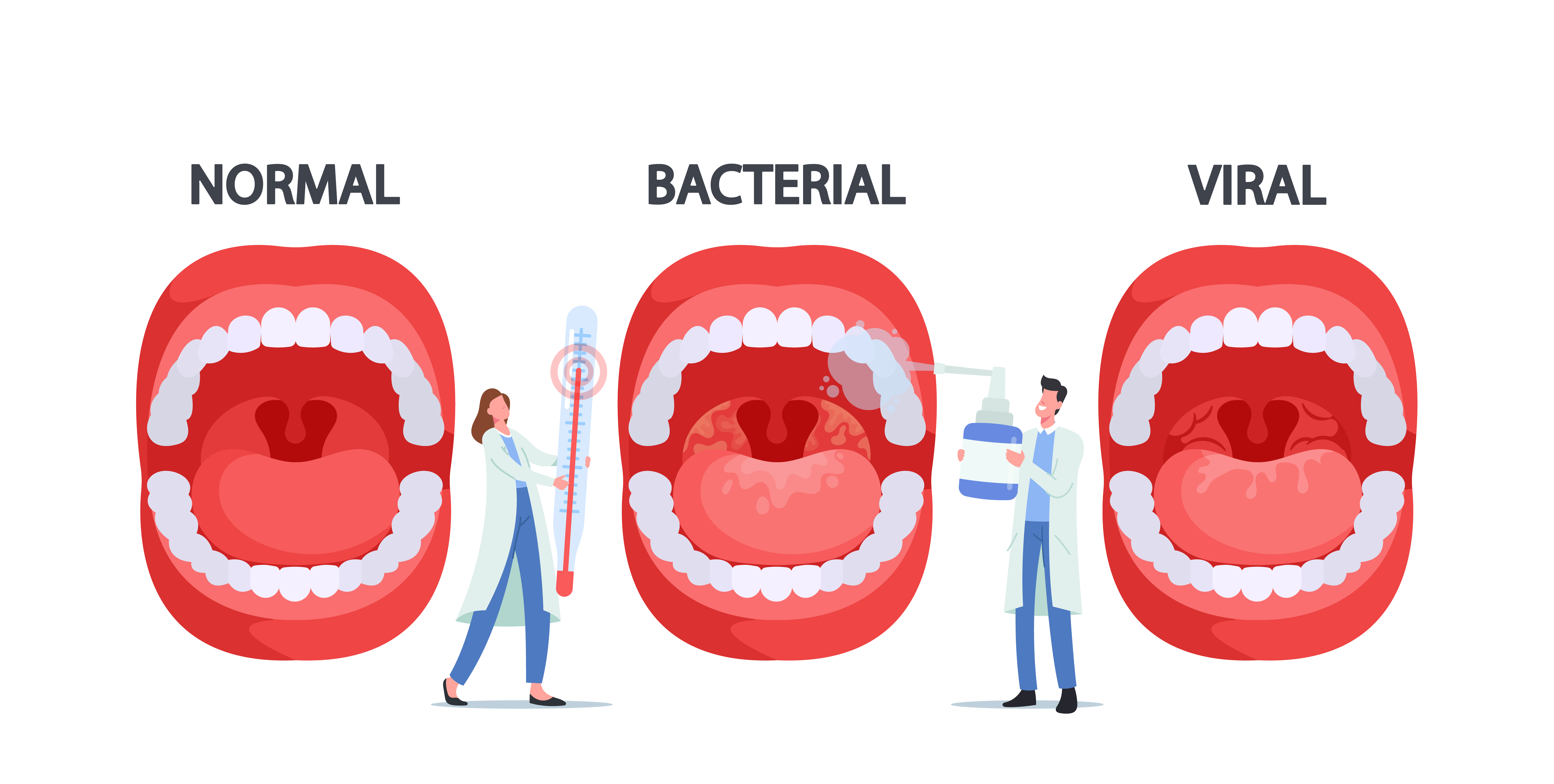 Ilustración vectorial que muestra una infección por la bacteria Streptococcus Thermophilus de las amígdalas | Fuente: Getty images