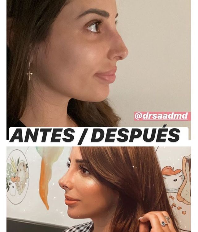 Jennifer Ortiz antes y después de la rinoplastia. | Foto: Captura de Instagram/jenniferora