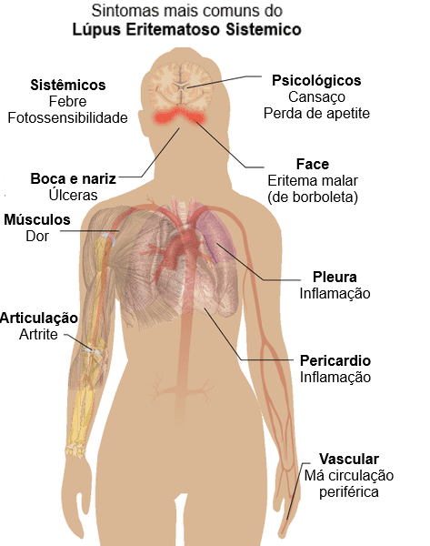 Síntomas de lupus eritematoso. | Foto: Wikimedia Commons