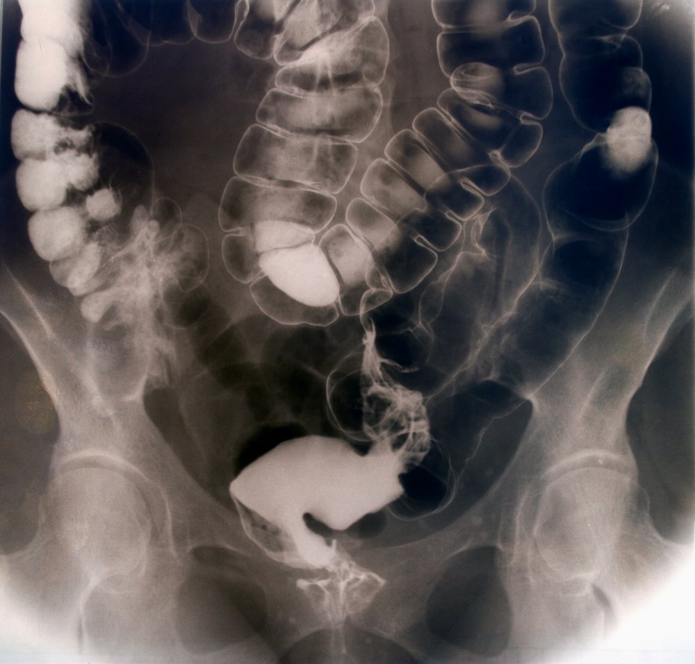 Radiografía intestinal. Fuente: Shutterstock