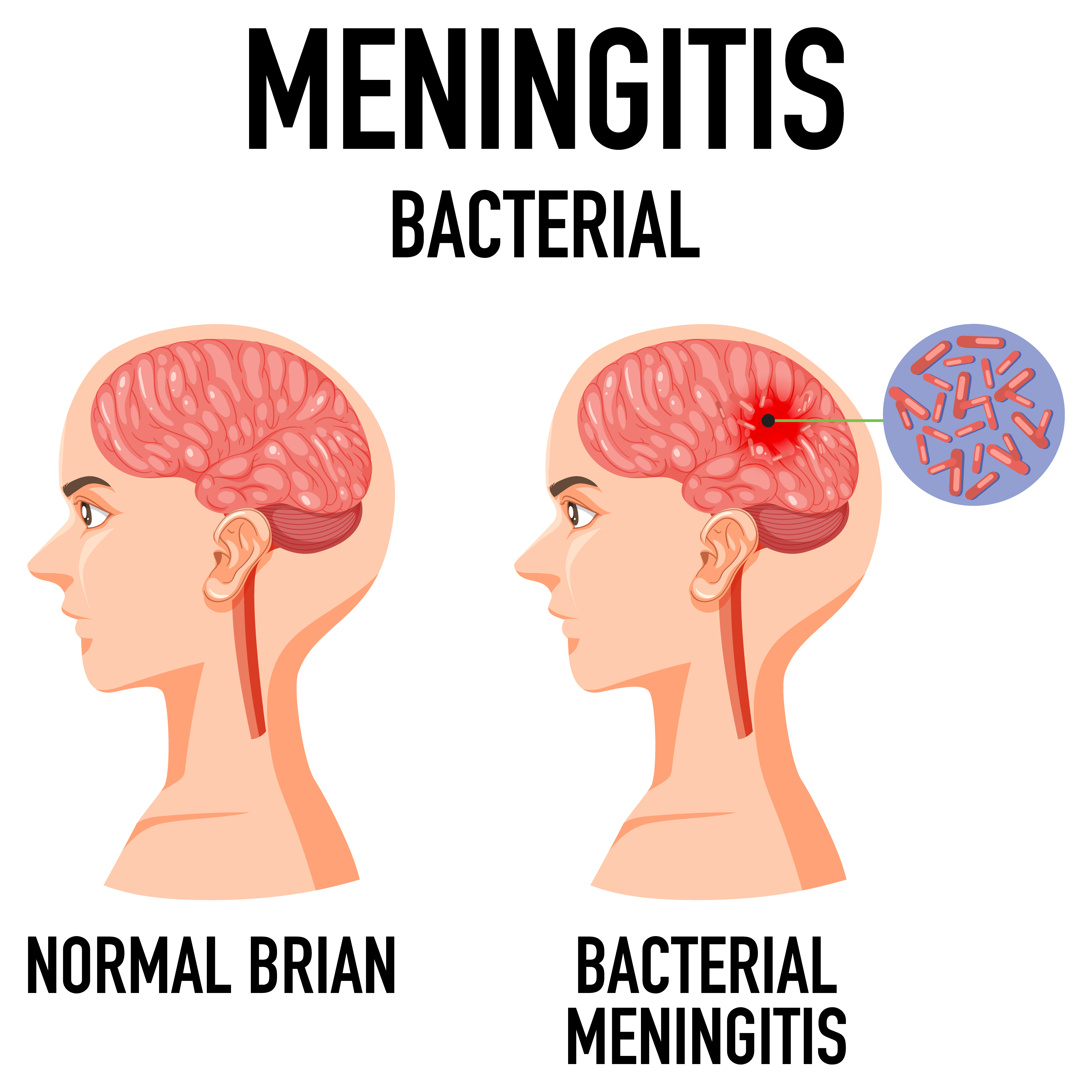 Diagrama de la meningitis bacteriana | Fuente: Getty images