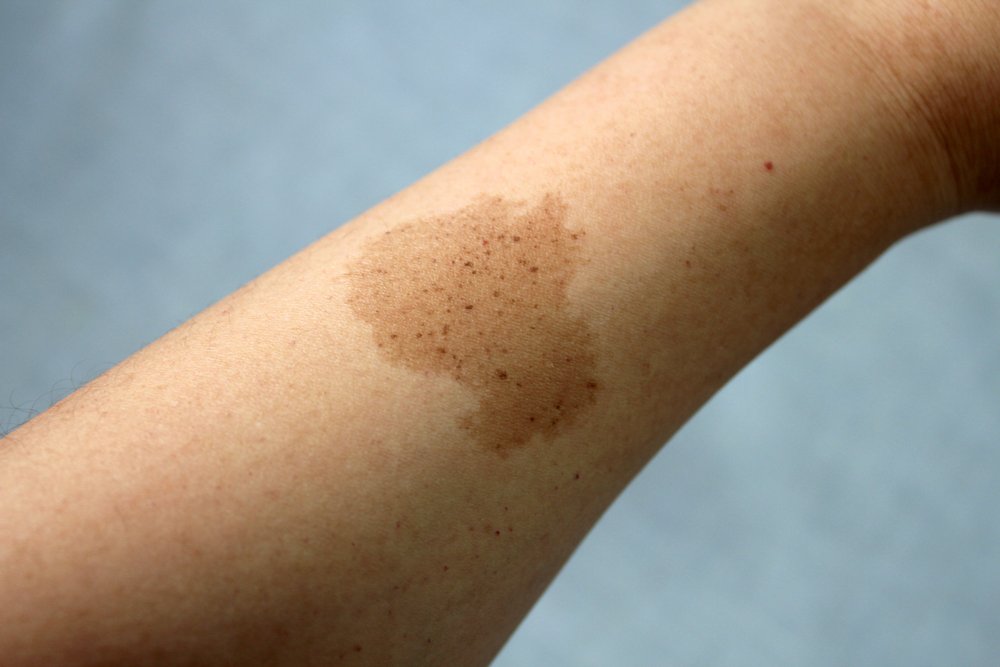 Marca de nacimiento en el brazo de una persona. | Foto: Shutterstock