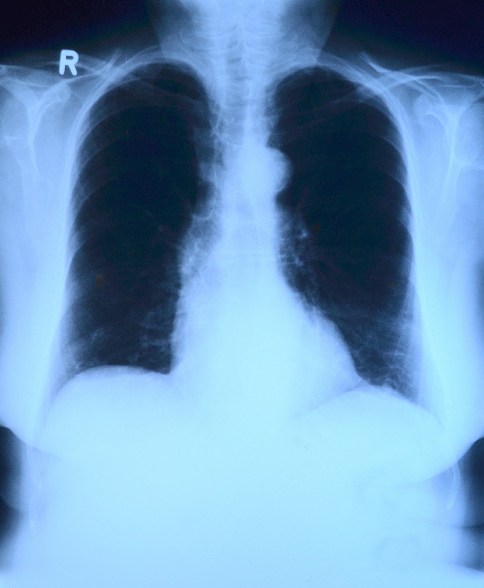 Radiografía de pulmones. │Foto: Pixabay