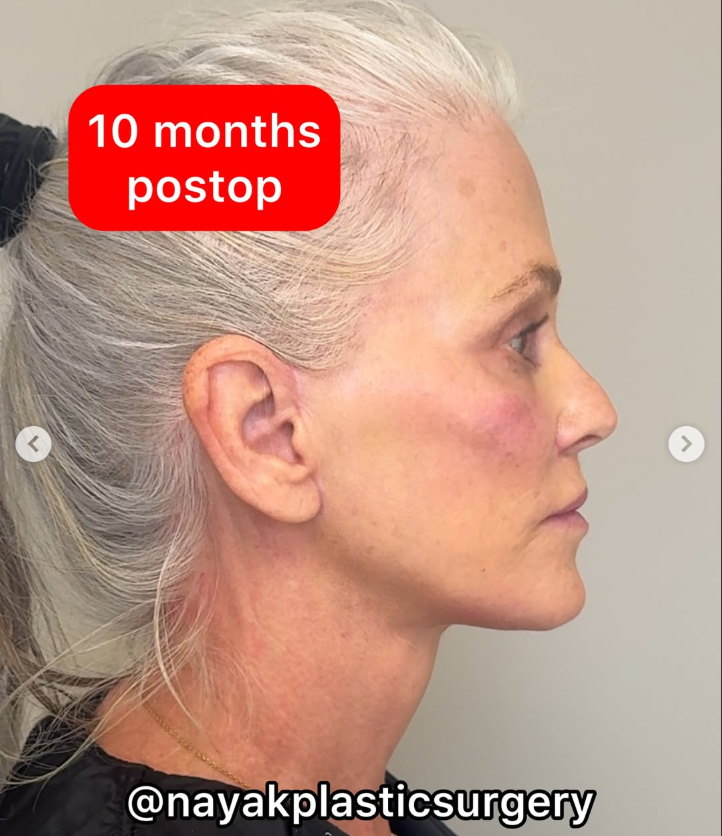 Lisa postoperada, de un post del 4 de abril de 2025 | Fuente: Instagram/nayakplasticsurgery