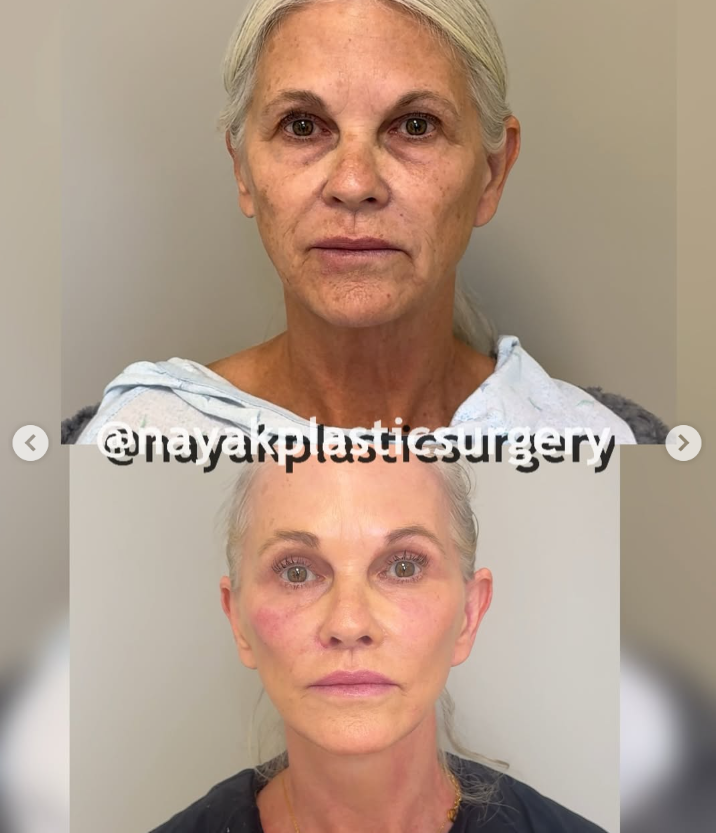 Fotos del antes y el después de Lisa, de un post del 4 de abril de 2025 | Fuente: Instagram/nayakplasticsurgery