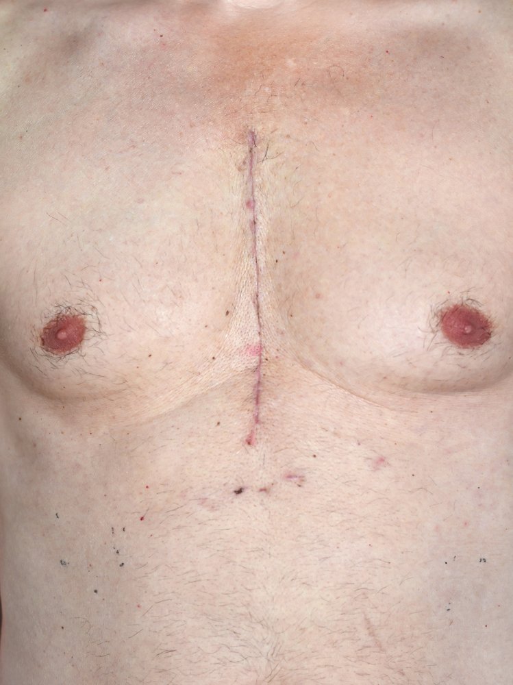 Cicatriz de cirugía a corazón abierto. || Fuente: Shutterstock
