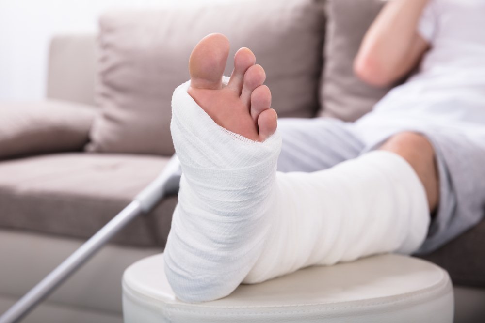 Hombre con pierna enyesada tras fractura. Fuente: Shutterstock