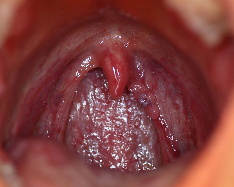 Verrugas en la garganta causadas por el virus del papiloma humano (VPH). | Imagen: Wikimedia Commons