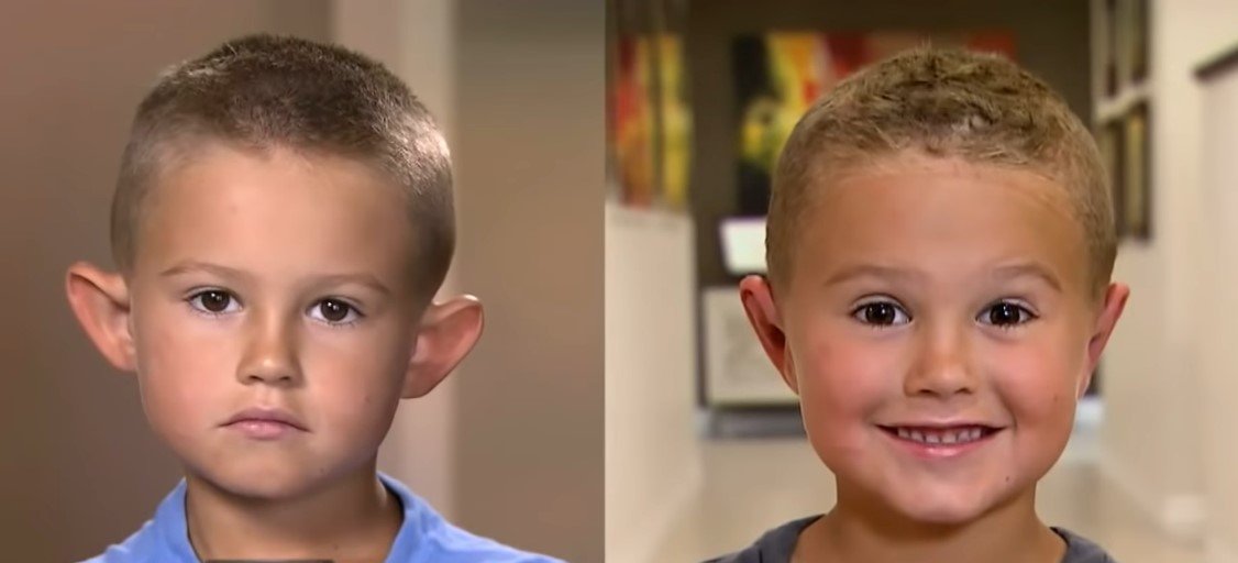 Gage Berger, de seis años, antes y después de la cirugía. | Foto: Youtube/Inside Edition