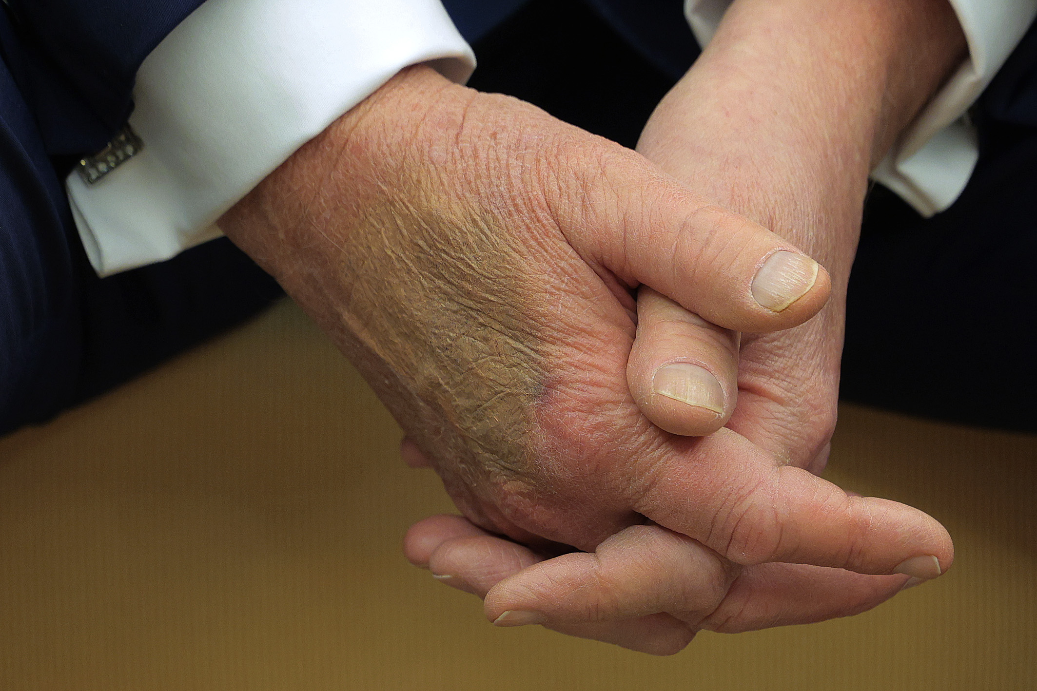 El maquillaje cubre un moratón en el dorso de la mano de Donald Trump mientras recibe a Emmanuel Macron para reunirse en la Casa Blanca en Washington, DC, el 24 de febrero de 2025 | Fuente: Getty Images