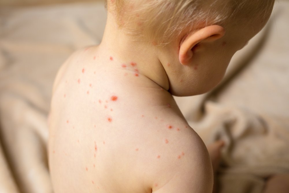 Bebé con sarampión. Fuente: Shutterstock