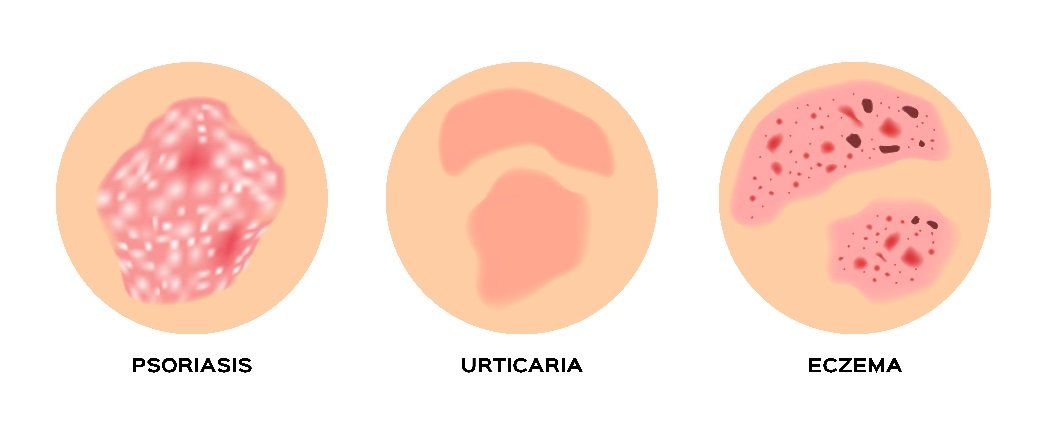 Lesiones de psoriasis, urticaria y eczema. Fuente: Shutterstock