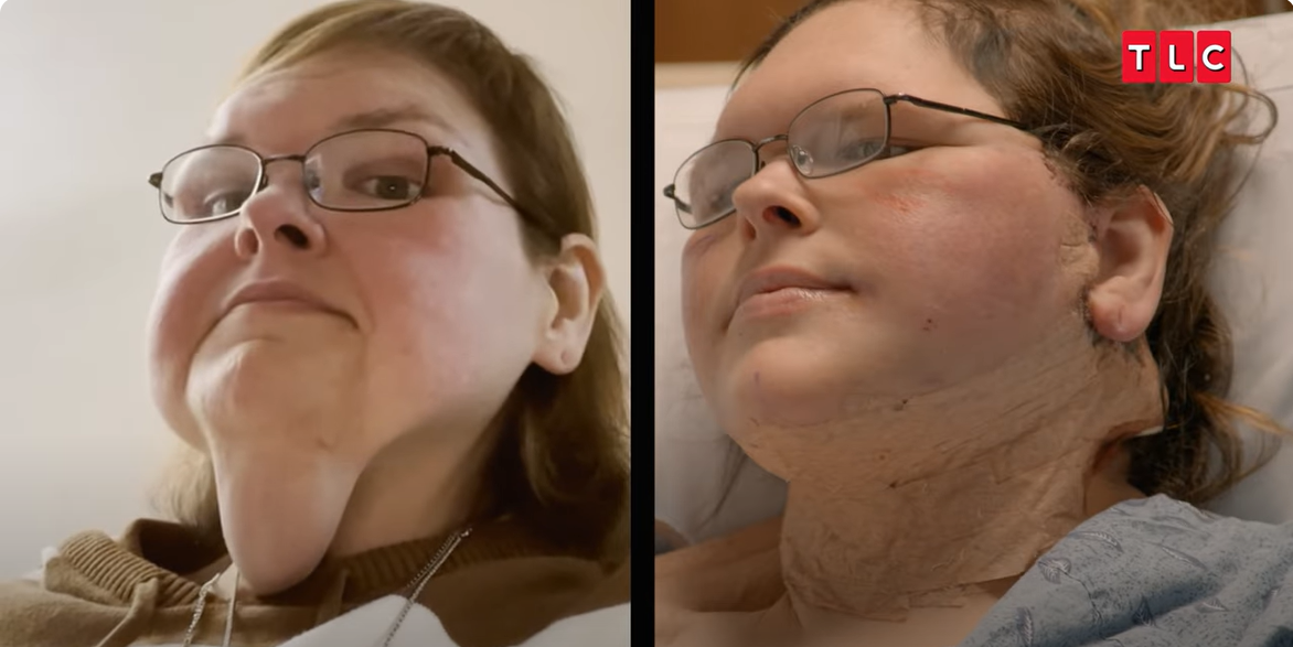 Foto de Tammy Slaton antes y después de la operación, de un vídeo publicado el 6 de junio de 2025 | Fuente: YouTube/TLC
