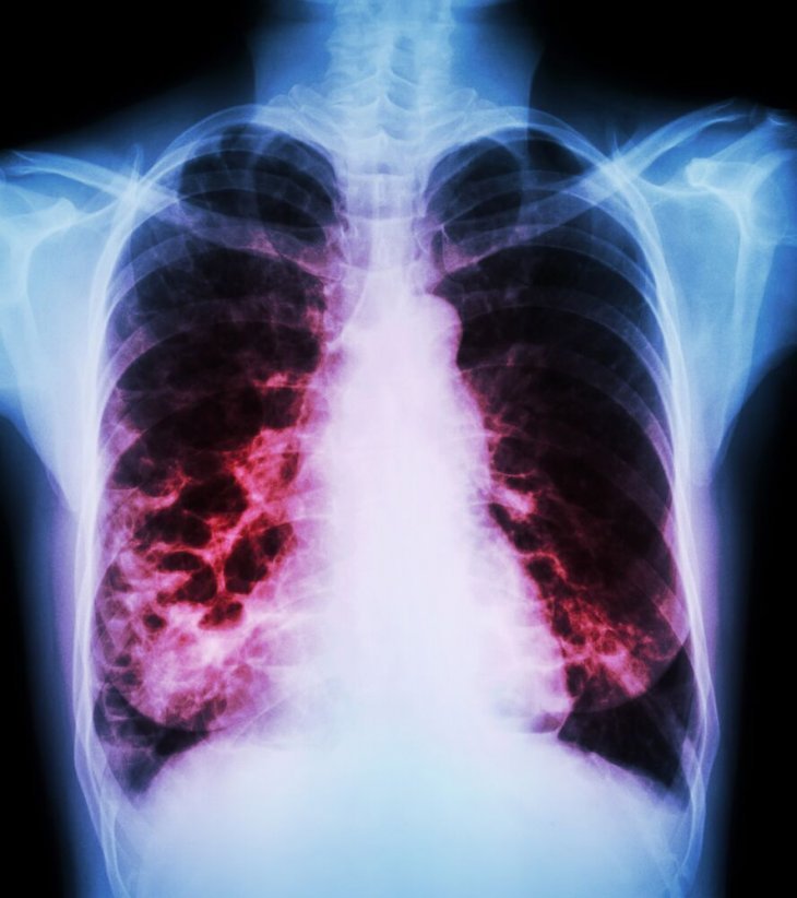 Rayos X de pulmones. | Foto: Shutterstock