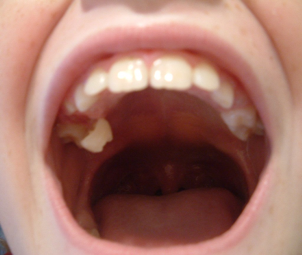Boca abierta con molar desprendiéndose de la encía. | Imagen: Flickr