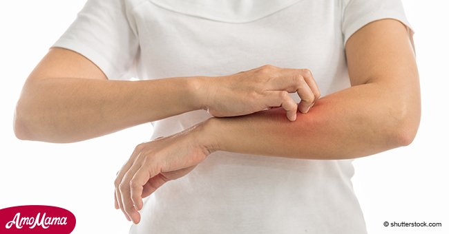 5 tips efectivos para evitar que el eczema vuelva a tu vida