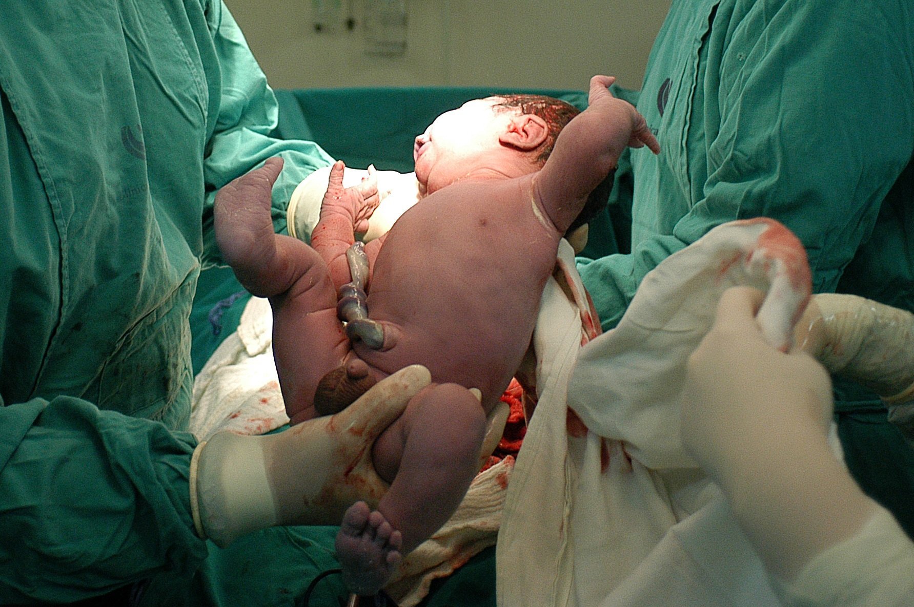 Recién nacido en el quirófano. | Foto: Wikimedia