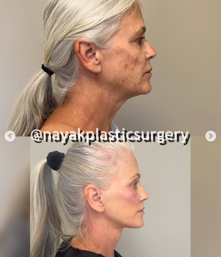 Fotos del antes y el después de Lisa, de un post del 4 de abril de 2025 | Fuente: Instagram/nayakplasticsurgery