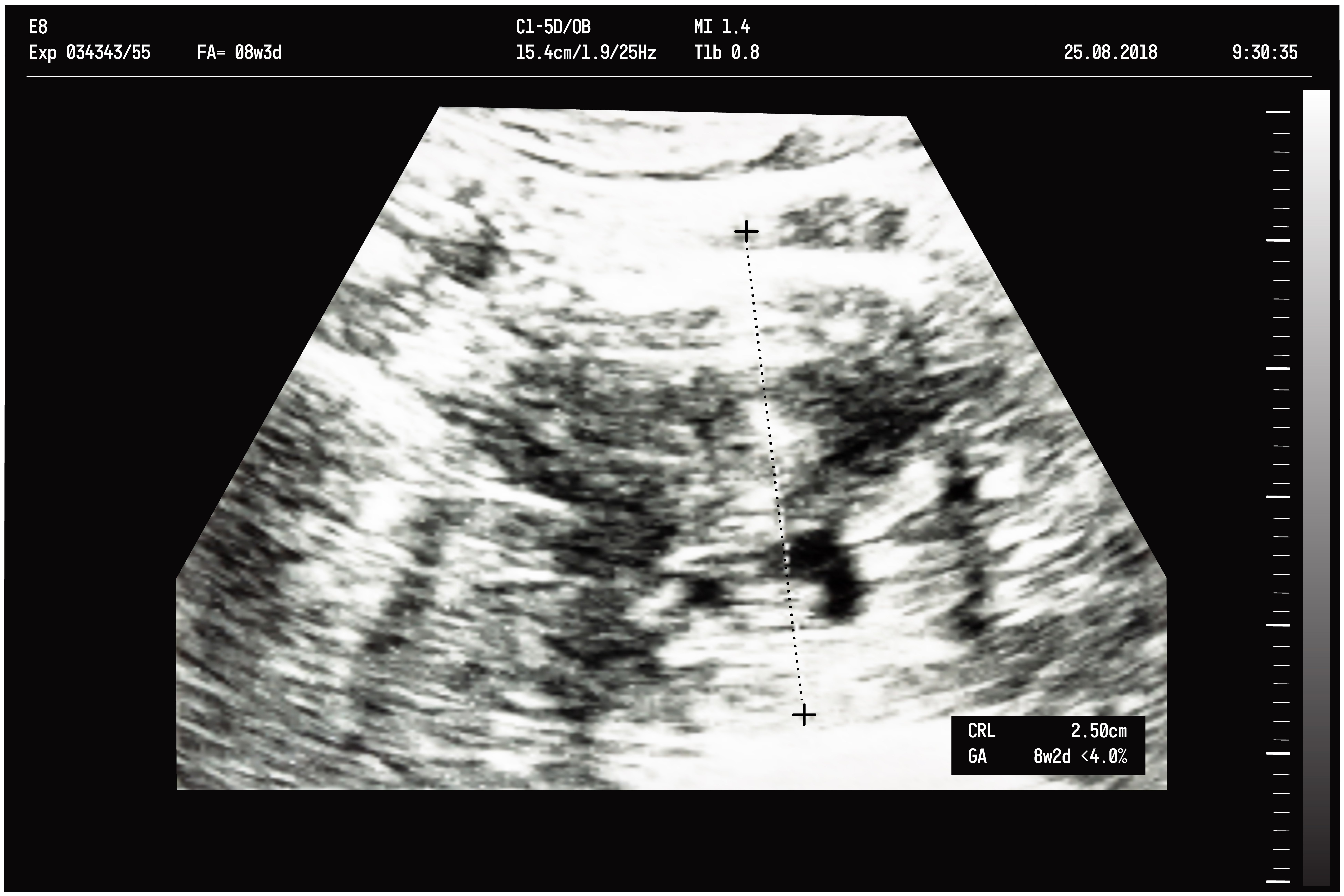 Ultrasonido de un feto durante la octava semana de gestación. | Fuente: Shutterstock