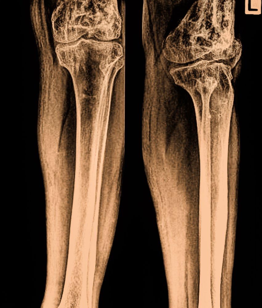 Huesos de las piernas.| Imagen tomada de: Shutterstock.